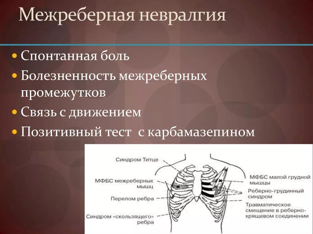Симптомы межреберной невралгии слева под ребрами