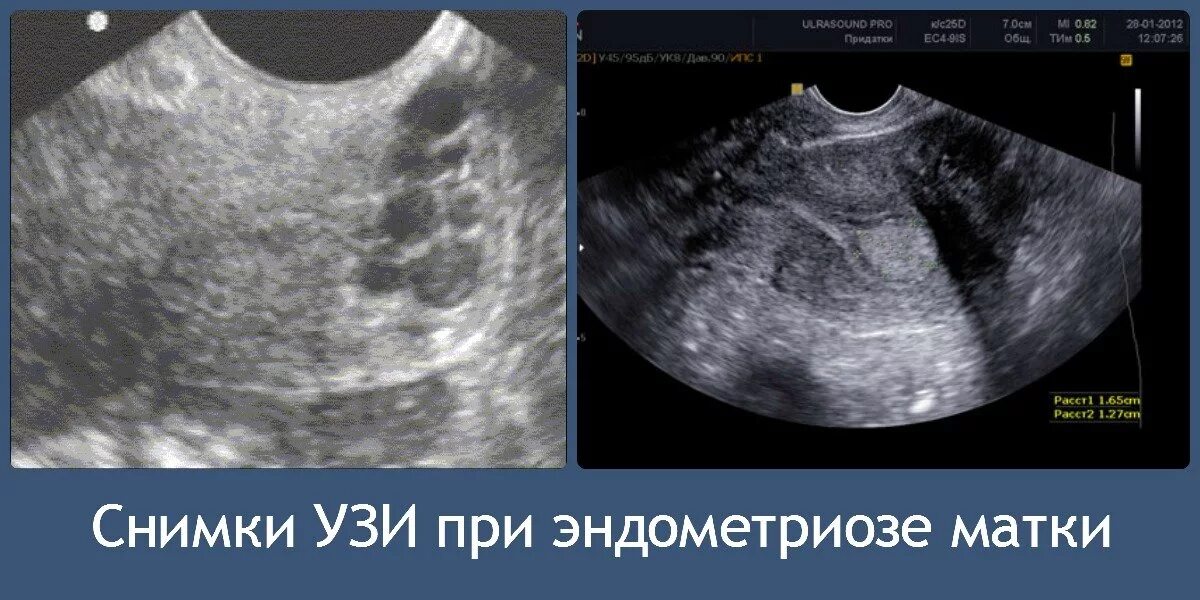 Признаки внутреннего эндометриоза на узи. Эндометриоз шейки матки на УЗИ. Внутренний эндометриоз тела матки УЗИ. Снимок УЗИ. Снимки УЗИ.