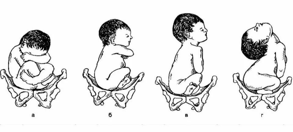 Тазовое предлежание показание. Ягодичное предлежание плода позиция 1. Тазовое ножное предлежание плода. Варианты положения головки плода при тазовом предлежании. Тазовое предлежание плода позиции.