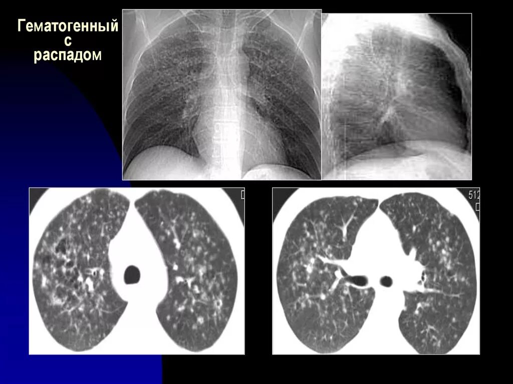 Лимфогенный туберкулез. Лимфогенный диссеминированный туберкулез. Диссеминированный туберкулез легких на кт. Диссеминированный туберкулез на кт. Лимфогенный диссеминированный туберкулез легких на кт.