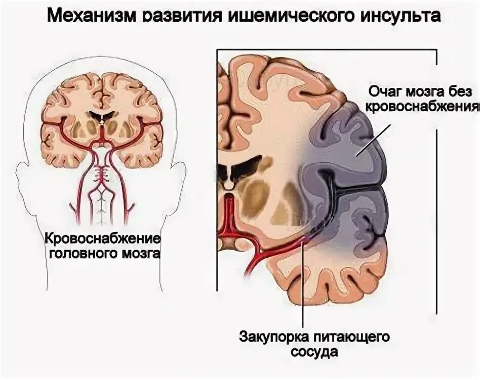 Проблемы пациента при ишемическом инсульте. Проблемы пациента при ишемическом инсульте