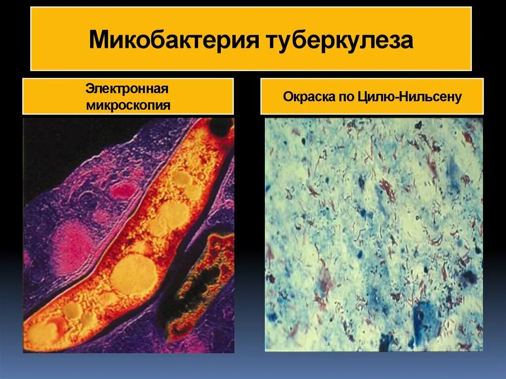 Туберкулез tuberculosis. Микобактерии туберкулеза электронная микроскопия. Возбудитель туберкулеза люминесцентный микроскоп. Палочка Коха Mycobacterium tuberculosis. Микобактерии туберкулеза микроскопия.