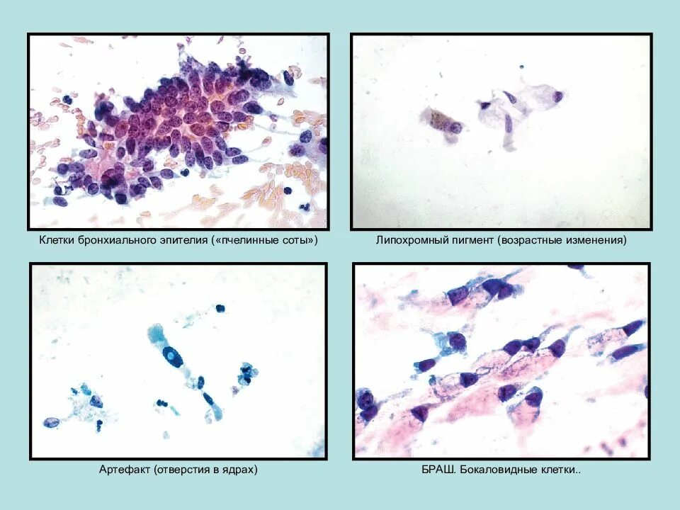 Реактивные изменения в цитологическом. Цилиндрический эпителий цитология. Клетки бронхиального эпителия. Цилиндрический эпителий риноцитограмма. Туберкулез клетки цитология.
