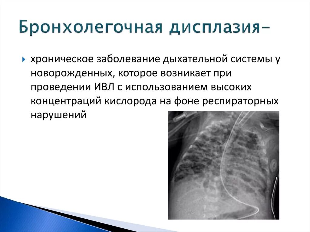 Профилактика бронхолегочных осложнений. Бронхопульмональная дисплазия. Бронхолегочная дисплазия кт легких. Бронхолегочная дисплазия у детей.