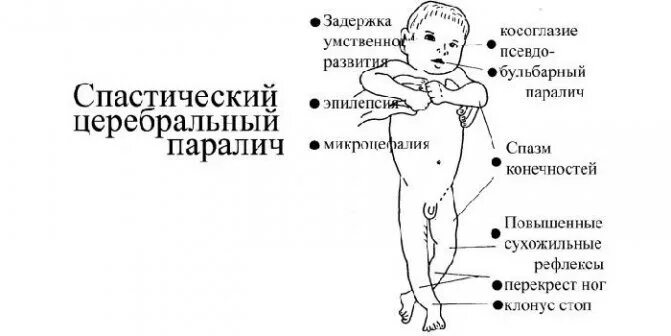 Дцп у новорожденных симптомы. Дцп у новорожденных симптомы
