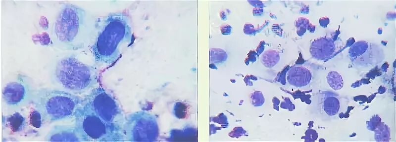 Реактивные изменения метаплазированных клеток. Атрофический Тип мазка микроскопия. Метаплазированный эпителий цитограмма. Клетки метаплазированного эпителия в мазке. Клетки метаплазированного эпителия в мазке на цитологию что это.