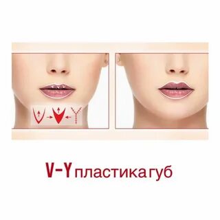 Пластика увеличения губ
