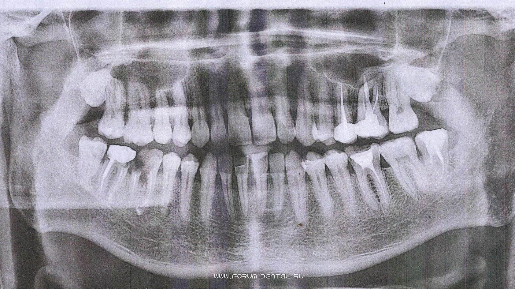 Корни передних зубов рентген.