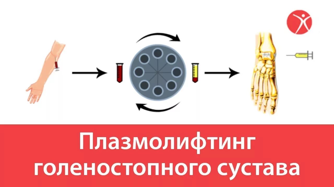 Плазмотерапия при заболеваниях суставов. Плазмолифтинг тазобедренного сустава. Плазма терапия коленного сустава. PRP плазмолифтинг суставов. Плазмолифтинг колена отзывы