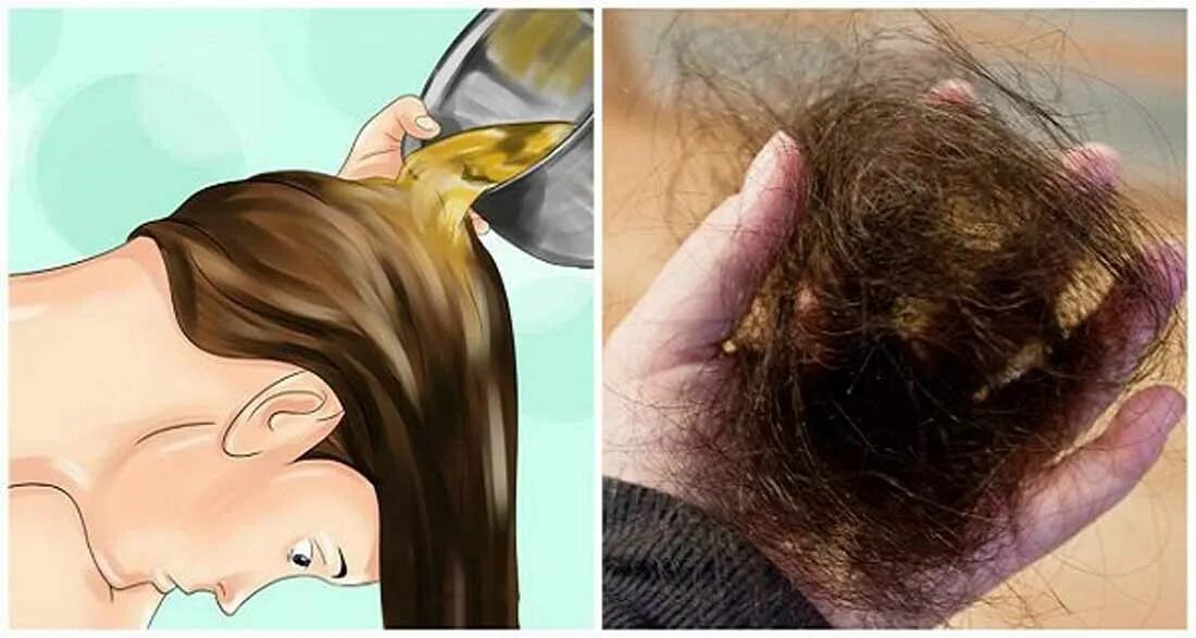 Сильно лезут волосы на голове у женщин. Послеродовое выпадение волос.