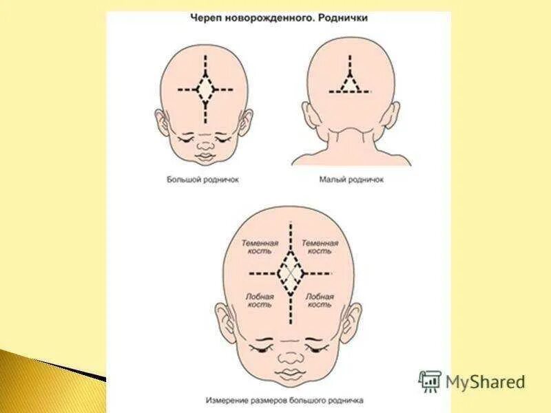 Большой и малый Родничок у новорожденного. Норма родничка у новорожденного. Форма большого родничка у новорожденного. Темечка на голове у ребенка.