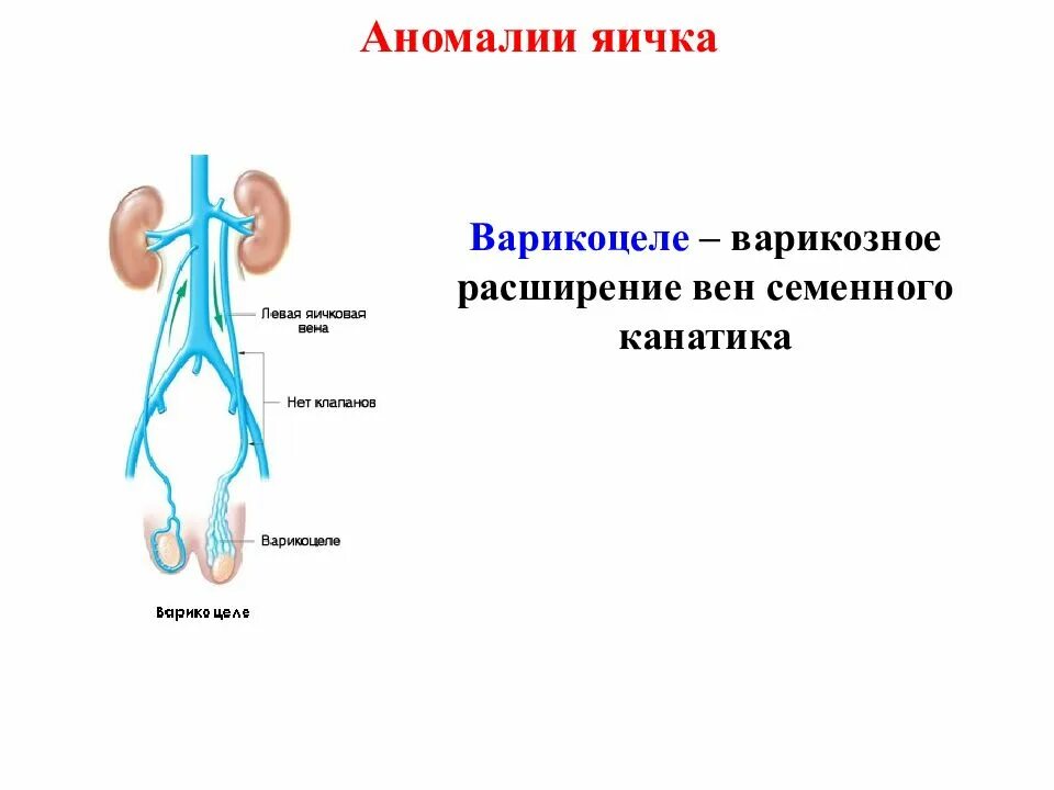 Расширение вены семенного канатика. Варикоцеле-расширение вен семенного канатика яичка. Варикоз вен семенного канатика. Варикозное расширение вен семенного канатика яичка.. Расширение вен семенного канатика.