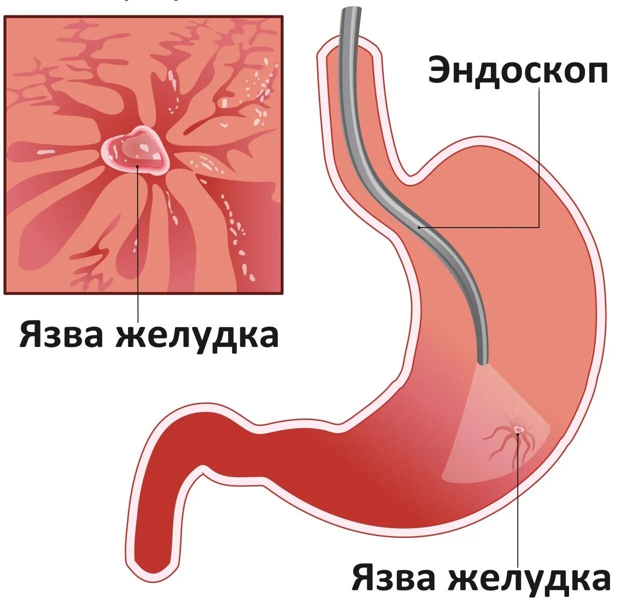 Язвенная болезнь желудка и язва желудка. Язвенная болезнь желудка эндоскоп. Язва двенадцатиперстной кишки ФГДС. Язва симптомы и лечение у взрослых