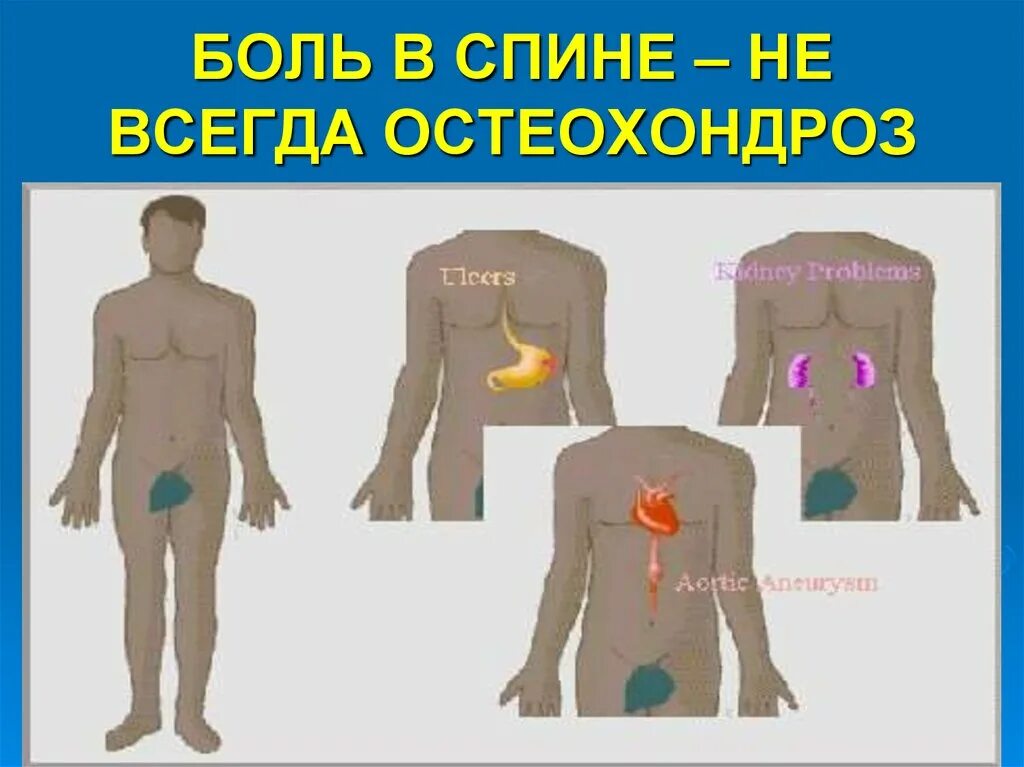 Болевые синдромы в неврологии. Миофасциальный болевой синдром остеохондроз.