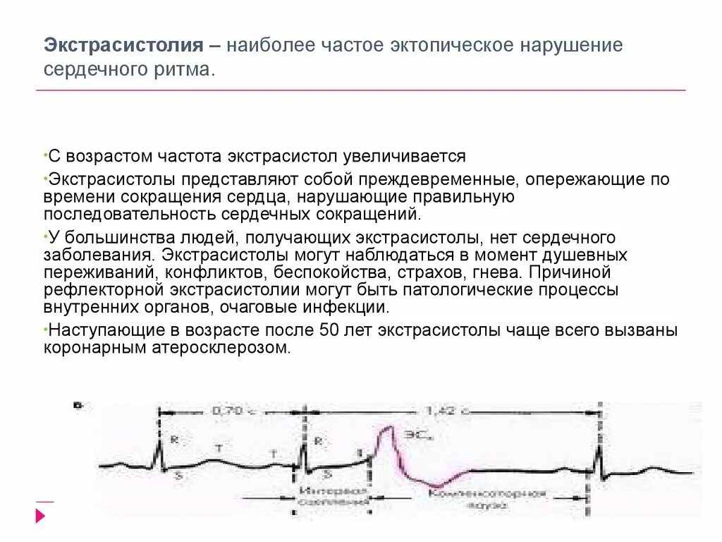 Экстрасистолия характеристика пульса. Нарушение ритма сердца экстрасистолия. Экстрасистолия нарушение проводимости. Ритма частые экстрасистолы нарушение. Экстрасистолы много