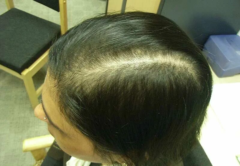 Редеют волосы. Телогеновая алопеция волос. Пробор лысина. Гиперандрогенная алопеция. Андрогенетическая алопеция.