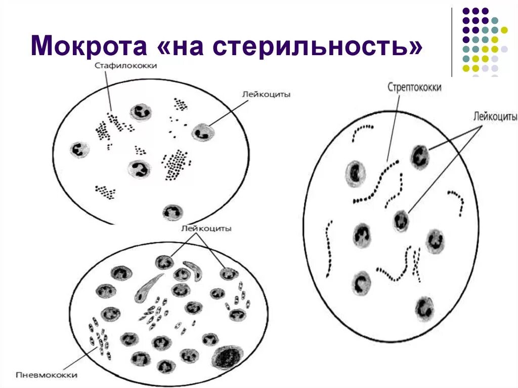 Образование мокроты. Клеточные элементы мокроты микроскопия. Клетки при микроскопии мокроты. Эластические волокна в мокроте микроскопия. Мокрота нативный препарат микроскопия.