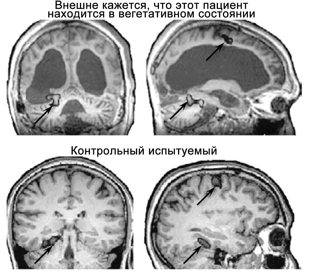 Диэнцефальная дисфункция головного мозга. Диэнцефальные отделы мозга это. Активность мозга при окр. Базально диэнцефальные структуры. Вегетативная состояние мозга.