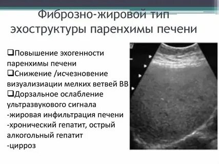 Структура поджелудочной диффузно неоднородная эхогенность повышена