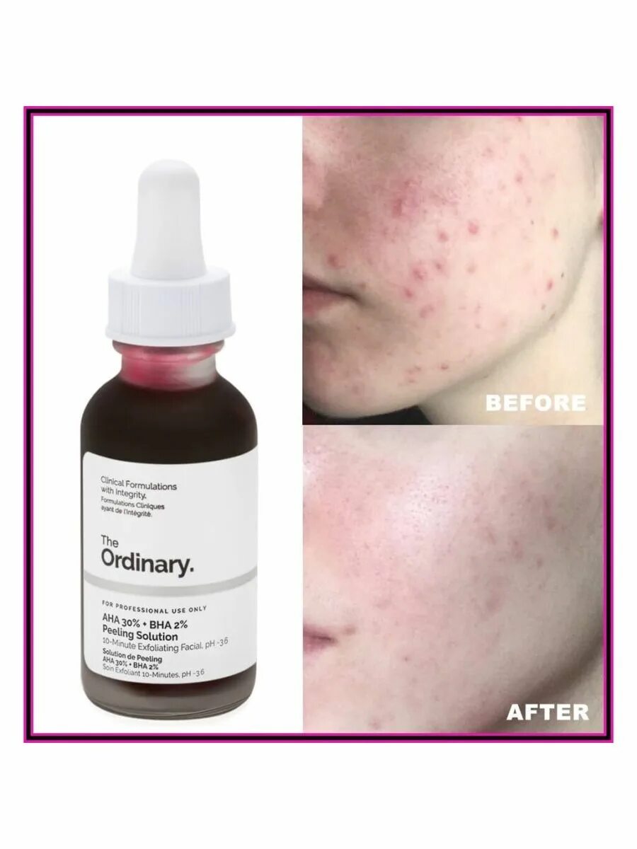 Aha 30% + BHA 2% peeling solution - 30ml. Кровавый кислотный пилинг the ordinary. Aha 30% + BHA 2%. The ordinary / кислотный пилинг Aha 30% + BHA 2%. После кровавого пилинга