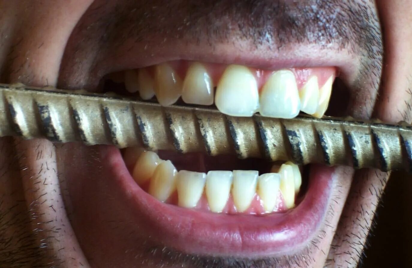Почему сжимаются зубы. Стираемость зубов бруксизм. Бруксизм скрежетание зубами.
