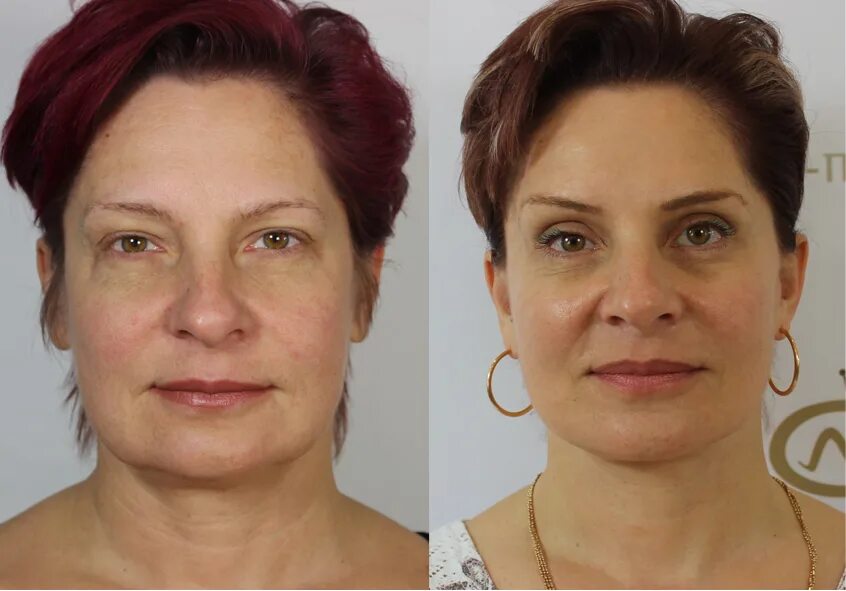 Эндоскопическая подтяжка лица. Фейслифтинг для лица. Круговая биопластика лица. Пластическая операция подтяжка лица. Подтяжка лица до и после.