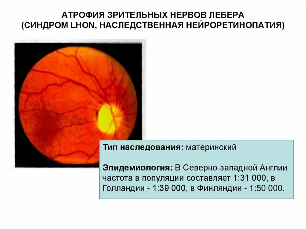 Нейропатия глаза. Распространенность атрофии зрительного нерва Лебера. Синдромы болезни Лебера. Наследственная нейропатия Лебера.