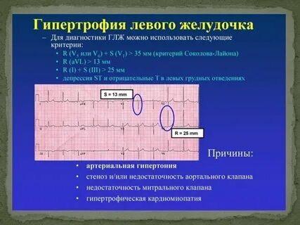 Индекс экг