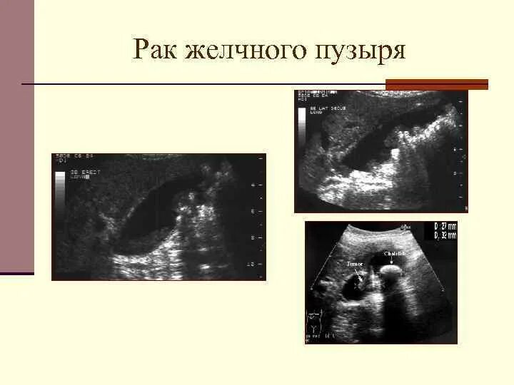 Опухоль желчного пузыря рентген. УЗД опухолей желчного пузыря. Билиарная гипертензия на УЗИ. Карцинома желчного пузыря. Узи сократимости желчного пузыря