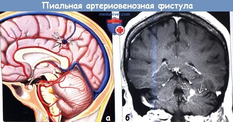 Дуральная артериовенозная фистула кавернозного синуса мрт. Артериовенозная фистула мозга. Дуральная артериовенозная фистула. Артериовенозная мальформация сосудов головного мозга на кт. Артериовенозная мальформация операция.