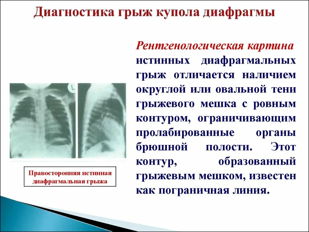 Грыжа диафрагмы лечение. Диафрагмальная грыжа рентген описание. травматическая диафрагмальная грыжа рентгенологическая картина. грыжа диафрагмы рентген признаки. диафранамальная грыжи.