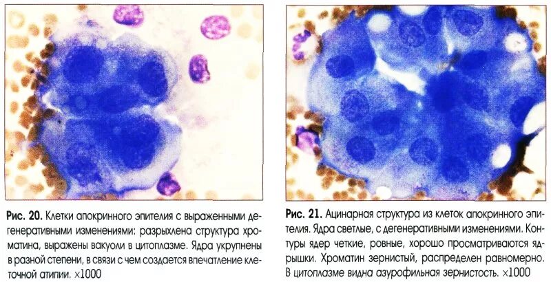 Макрофаги в молочной. Цитологическое исследование на атипичные клетки. Цитология мазок молочной железы. Гиперкератоз цитология мазка.