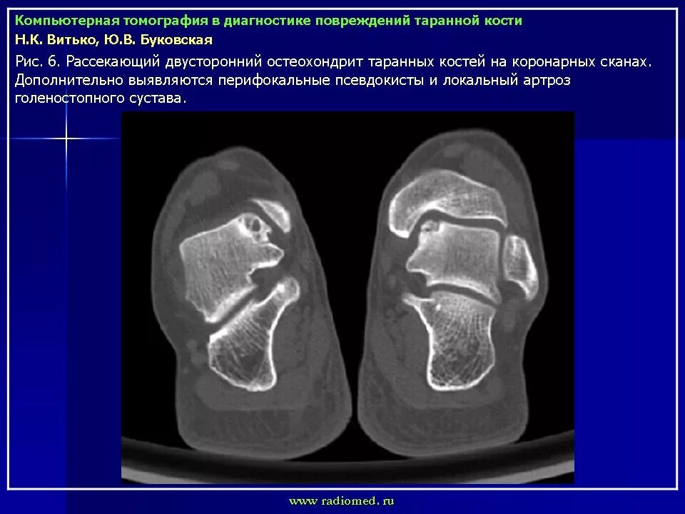 Остеомиелит таранной кости кт. Перелом таранной кости на кт. Перелом таранной кости диагноз.