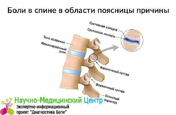 Почему болит область поясницы. Боли в спине причины. Боли в спине в области поясницы причины. Боль в пояснице у женщин причины.