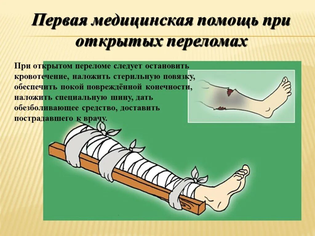 Д3 при переломах. ПМП при открытом переломе. Последовательность оказания ПМП при открытом переломе:. Первая помощь при открытом переломе с артериальным кровотечением. Как оказать первую медицинскую помощь при открытых переломах?.