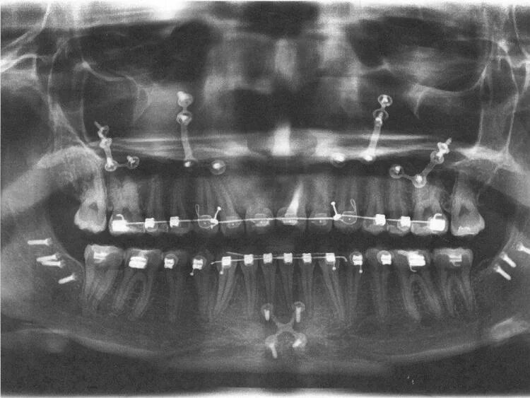 Мрт можно делать с брекетами на зубах. Ортопантомограмма пародонтит. Ортодонтический винт рентген. Ретенция клыка брекеты. Минивинты ортодонтические.