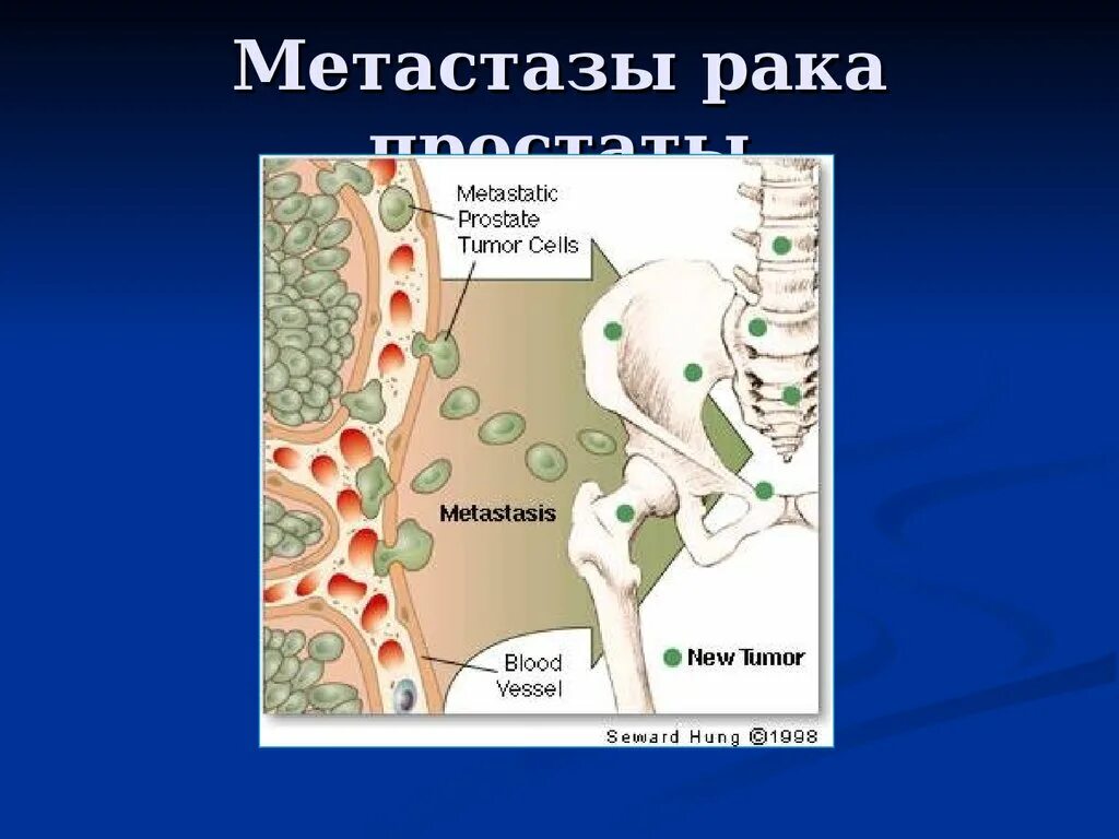 Какой рак метастазирует. Метастазирующие опухоли. Метастазирование предстательной железы.