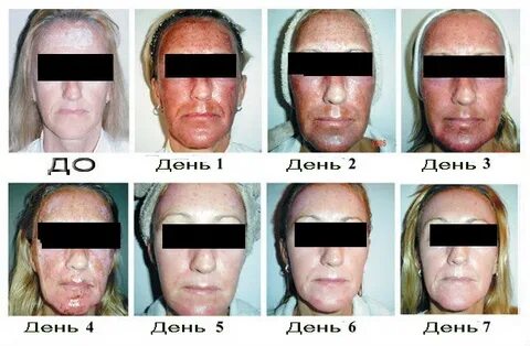 Уход за лицом после холодной плазмы