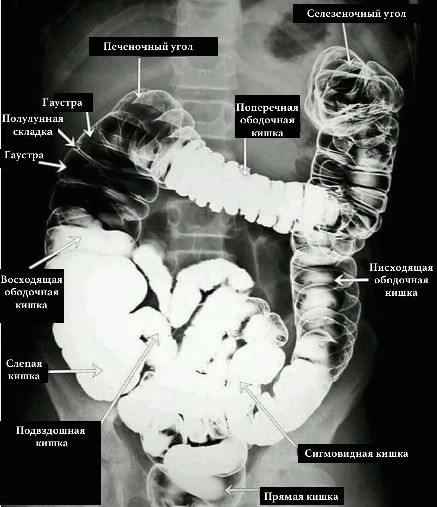Ирригоскопия Толстого кишечника рентген. Рентген анатомия Толстого кишечника. Отделы толстой кишки рентген. Ирригоскопия сигмовидной кишки. Удлинена сигмовидной