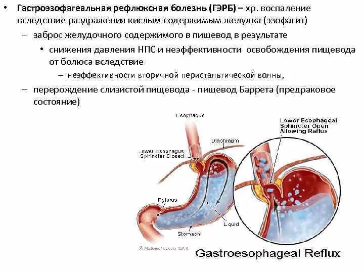 Заброс в пищевод симптомы и лечение. Гастроэзофагеальная рефлюкс-болезнь. Гастроэзофагеальнорефлюксной болезни. Газоэзофагальнаярефлюксная болезнь. Гастроэзофагеальная рефлюксная бол.