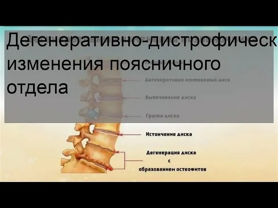 Дегенеративные изменения поясничного отдела. Дегенеративно-дистрофические изменения поясничного отдела. Дегенеративные изменения поясничного отдела позвоночника. Дегенеративные изменения пояснично-крестцового отдела.