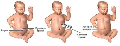 Заговорить пупочную грыжу