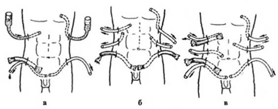Перитонит дренирование. Дренирование брюшной полости. Дренирование брюшной полости при перитоните. Методы дренирования брюшной полости при перитоните.