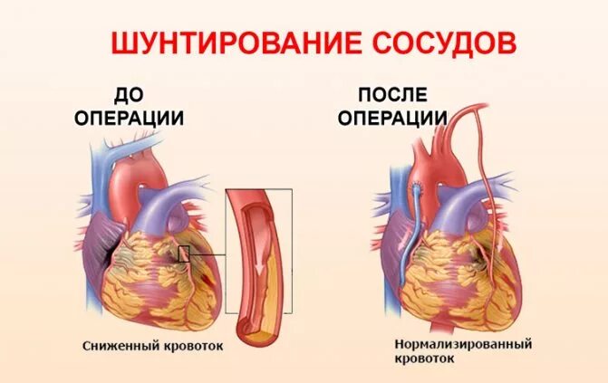 Шунт сосудов. Шунтирование при инфаркте миокарда операция. Шунты при коронарном шунтировании. Что такое шунтирование сердца при инфаркте миокарда. Коронарное шунтирование сосудов сердца.
