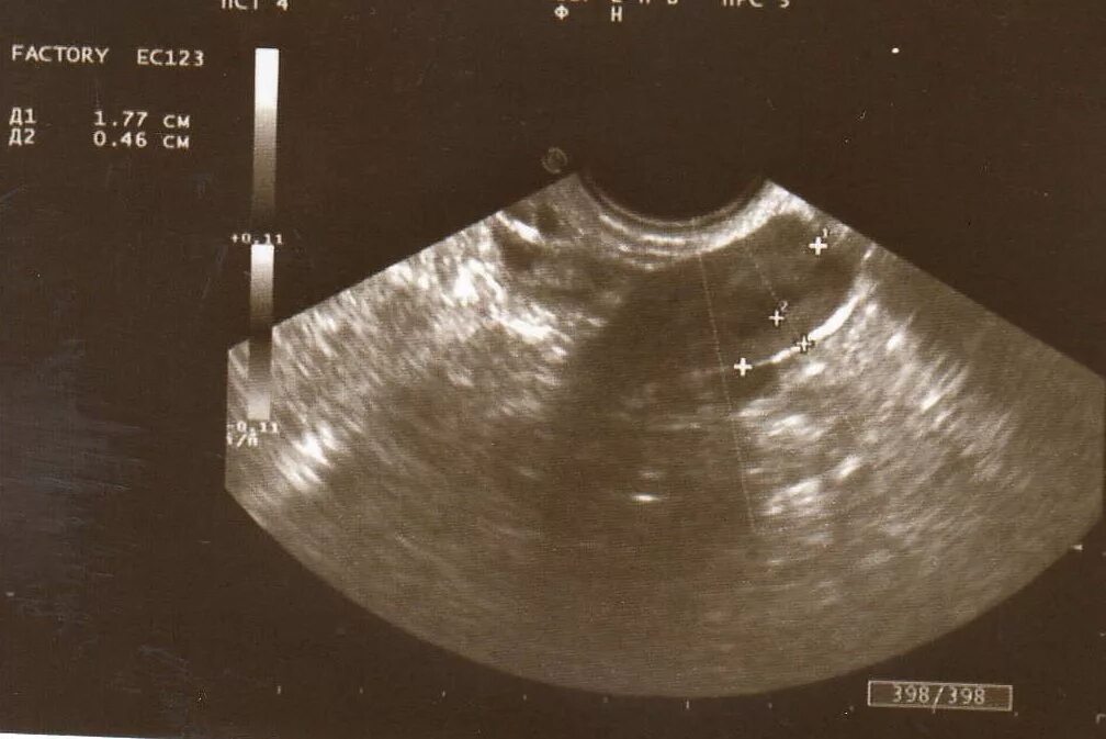 Подсаживали 2 эмбриона. УЗИ после переноса 2 эмбрионов при эко. УЗИ после подсадки эмбрионов.