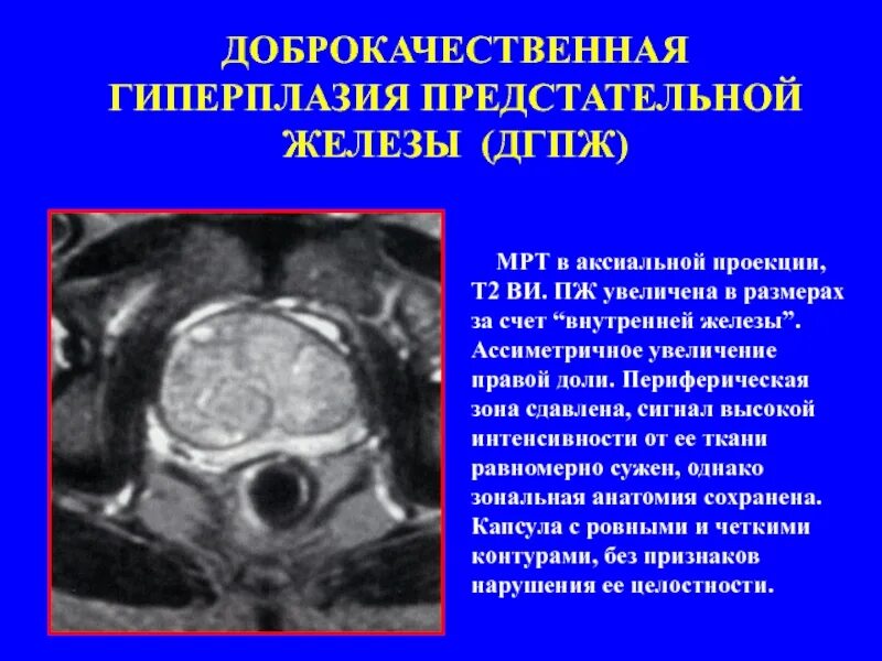 Аденома простаты мрт. Гиперплазия предстательной железы мрт. Аденома предстательной железы мрт. ДГПЖ В периферической зоне.