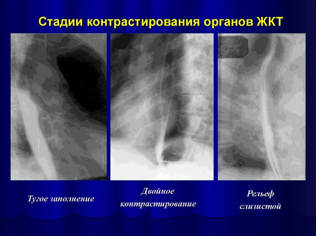 Лучевая пищевода. Фаза тугого наполнения пищевода. Рентгеноскопия пищевода норма. Нормальный пищевод на рентгене. Контрастирование пищевода рентген.