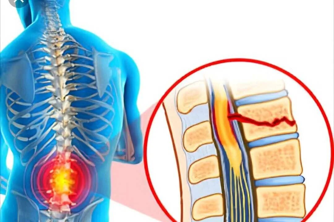 Отдел разрыв. Травма поясничного отдела позвоночника. Травматические повреждения позвоночника. Травма позвоночника, спины. Ушиб поясничного отдела позвоночника.