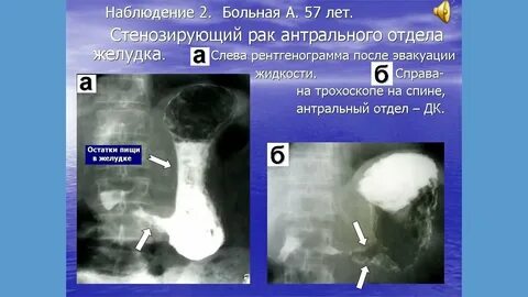 Рак привратника