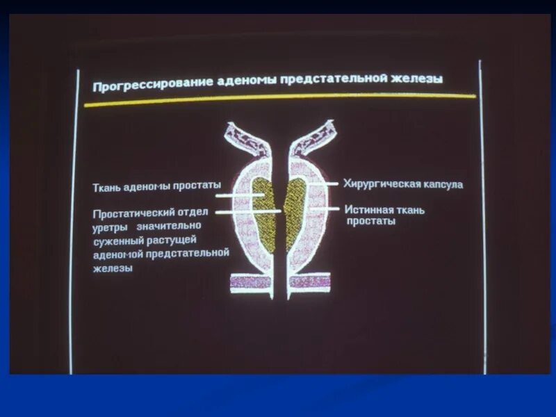 Капсула предстательной железы. Хирургическая капсула предстательной железы это. Хирургическая капсула предстательной железы на УЗИ. Анатомическая капсула предстательной железы. Хирургическая анатомия предстательной железы.